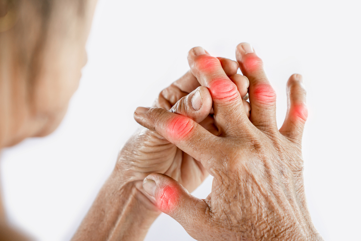 Painful gout affecting finger joint in older woman's hand