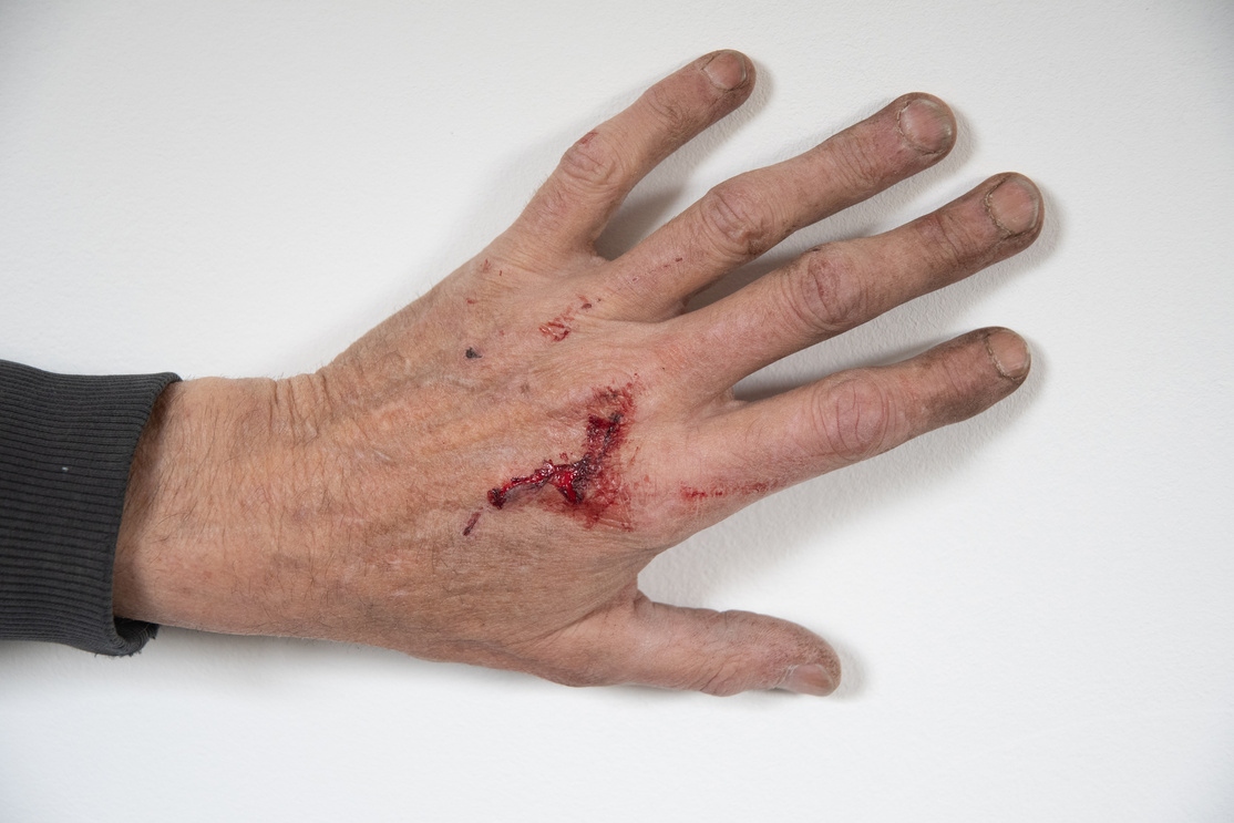 Bloody Wound of a Person's Left Hand